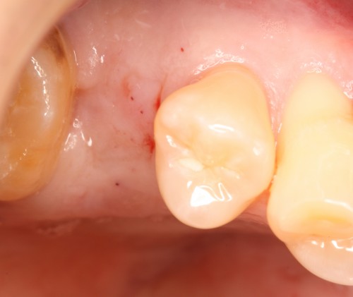 田村5　埋入直前